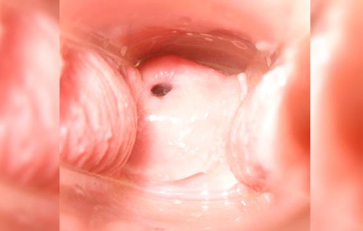 cervix