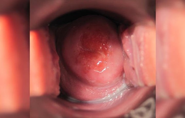 cervix