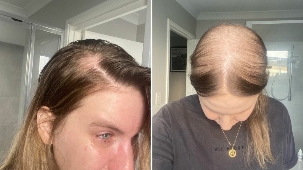 Hair loss from cancer as a hairdresser